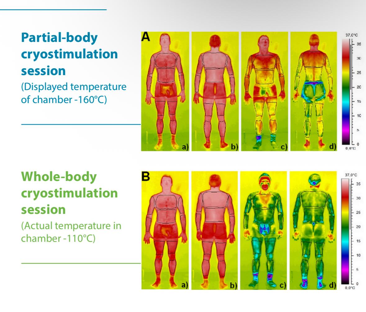 Thermal comparison showing partial-body cryostimulation versus whole-body cryostimulation, with broader and more even cooling across the body in the whole-body setup.